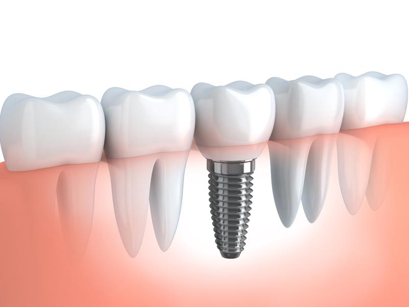 Dental Implants Woodland Hills, CA 