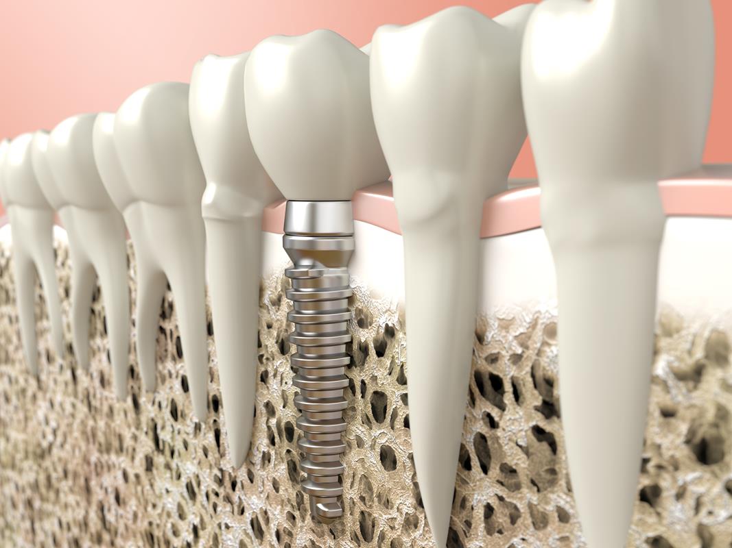 Dental Implants Woodland Hills, CA 